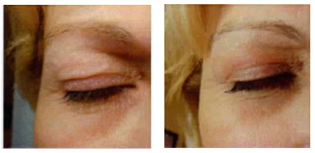 blepharoplastie-laser-resultats-avant-apres