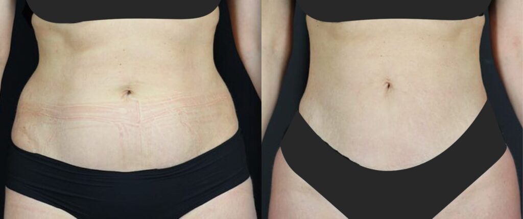 resultat-lipo-assistee-vibration